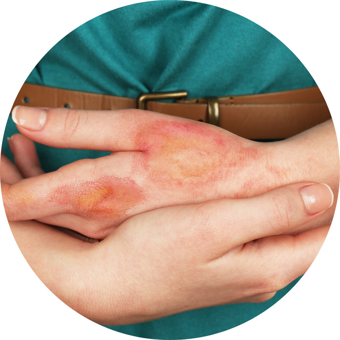 oparzenia Tlenoterapia na poparzenia