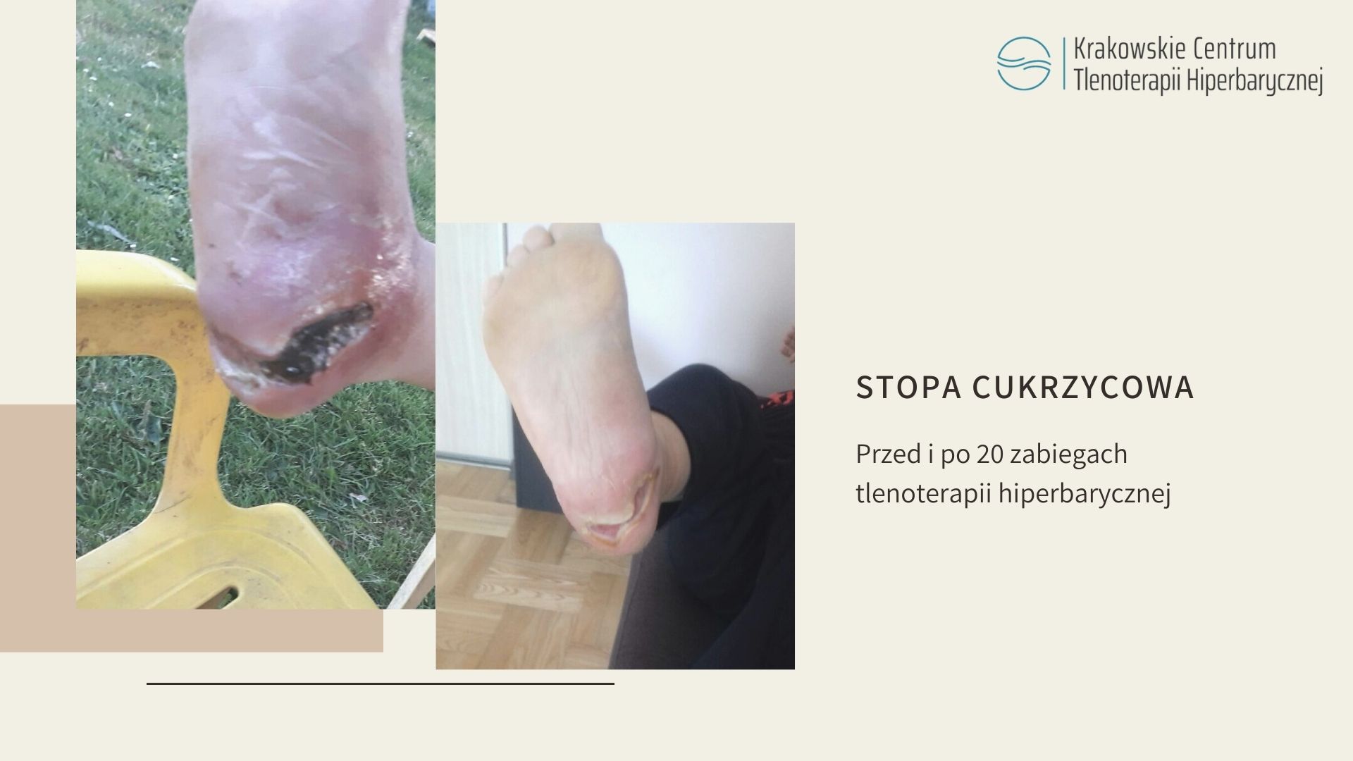 TLENOTERAPIA HIPERBARYCZNA – jak często i ile trzeba wziąć zabiegów w komorze hiperbarycznej?